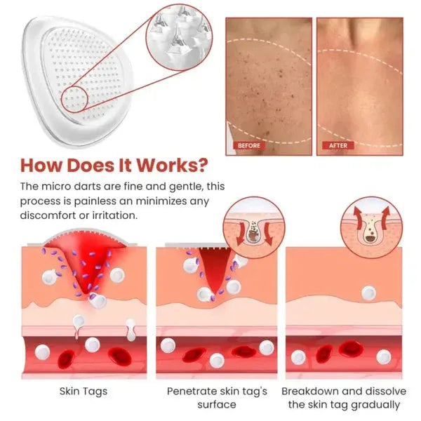 Mole Removal Patch – Fast, Safe, And Painless Skin Tag Removal Solution With No Scarring Or Pigmentation