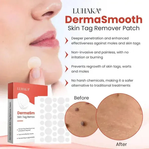 Mole Removal Patch – Fast, Safe, And Painless Skin Tag Removal Solution With No Scarring Or Pigmentation